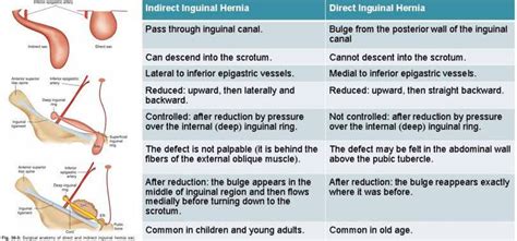 hernia inguinal directa vs indirecta